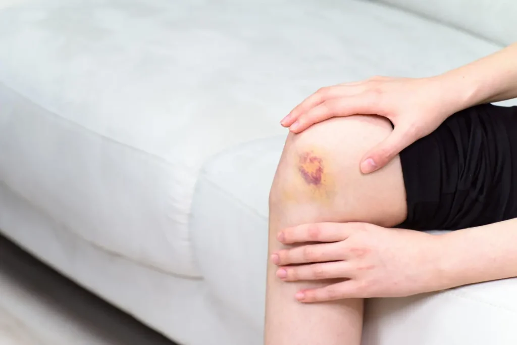 who have recently been injured and bruised Classified as a person prohibited from massage ผู้ที่เพิ่งบาดเจ็บฟกช้ำ จัดเป็นบุคคลห้าม นวด