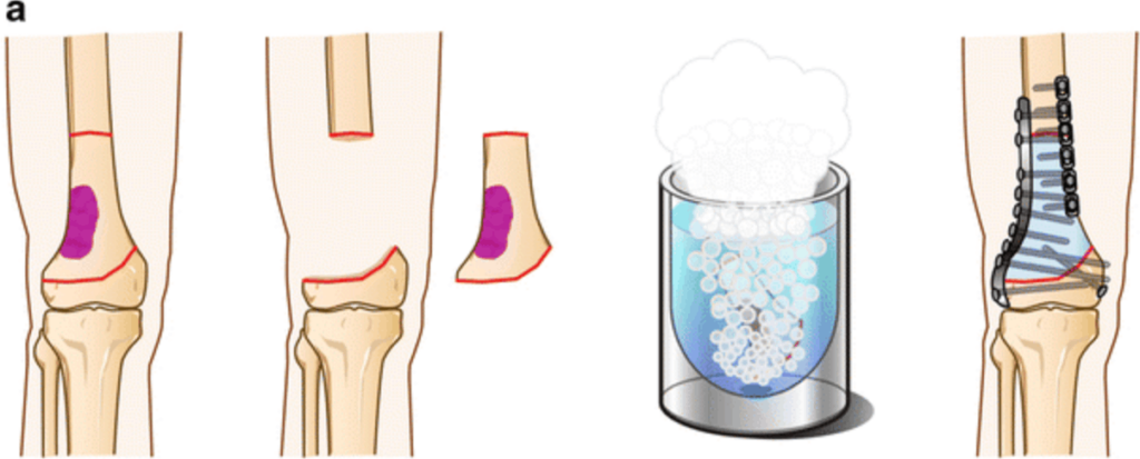 Recycling Bones Techniques - step by step to treat bone cancer