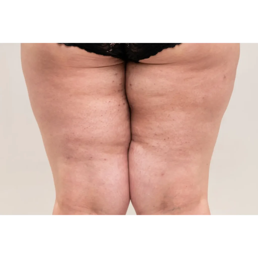 การเปลี่ยนแปลงขนาดขา ที่อาจจะไม่ใช่ภาวะโรค อ้วน แต่อาจเป็น มะเร็ง maybe leg size changing is not obesity but cancer.