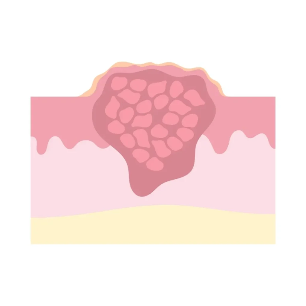 Chronic Non-Healing Wounds: Subtle Signs of Cancer Often Overlooked​ ก้อน ในร่างกาย