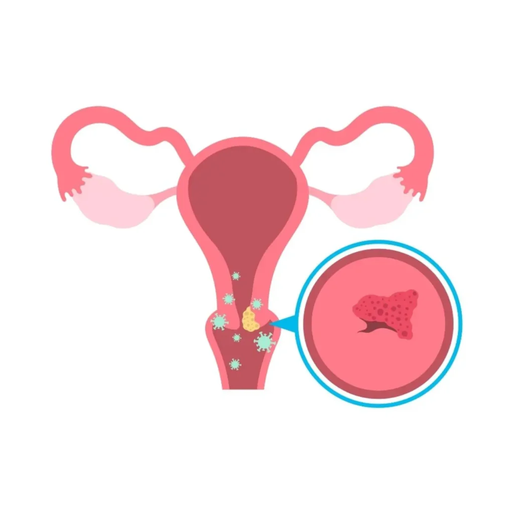 Abnormal Vaginal Discharge: Recognizing Gynecological Signs of Cancer​ อาการ มะเร็งปากมดลูก